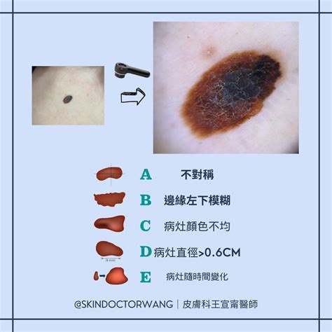 陰莖長痣|陰莖長黑痣 要找皮膚科｜性福教戰｜性愛｜元氣